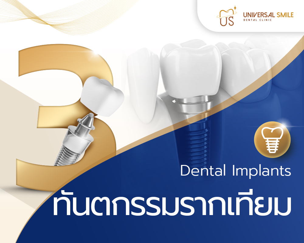 ทันตกรรมรากเทียม